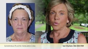 Facelift Necklift Tummy Tuck Denise Day of facelift surgery