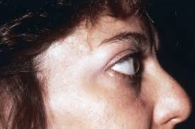 Hair loss is a possible symptom of hypothyroidism or hyperthyroidism. Thyroid Disease A Checklist Of Skin Hair And Nail Changes