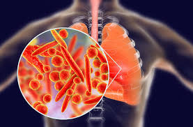 Check spelling or type a new query. What S The Difference Between Walking Pneumonia And Regular Pneumonia Health Essentials From Cleveland Clinic