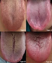 Image result for Fissured tongue