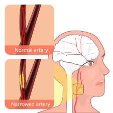 Image result for carotid artery