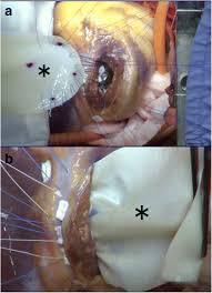 Never use bean bag filling, corn, stockings, foam rubber nor cut up rags. A Modified Multi Patch Technique For Double Layered Repair Of Ischemic Posterior Ventricular Septal Rupture Surgical Case Reports Full Text