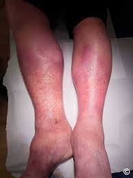 Lipodermatosclerosis