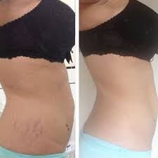 Stretch Mark Bio Oil Before And After Legs Pin On Diets And Such