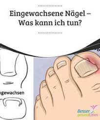 eingewachsene nagel was kann ich tun besser gesund leben eingewachsener nagel besser gesund leben gesundheit