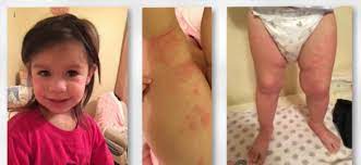 Reactions From Antibiotics Can Lead Children To Emergency Room Wral Com
