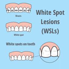 You just have to maintain regular tooth cleaning like brushing teeth at least twice a day and flossing at least once a day. Treating White Spot Lesions