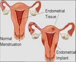 Marcello ceccaroni, direttore di ginecologia e ostetricia. L Endometriosi Causa Sintomi E Terapia Benessere Naturale