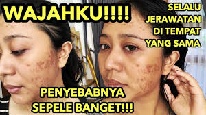 Tea tree oil adalah perawatan herbal yang dapat digunakan untuk mengatasi bisul berulang karena merupakan agen antibakteri dan antijamur. My Acne Story Penyebab Jerawat Tumbuh Di Tempat Yang Sama Jangan Sampe Kamu Juga Jadi Korban Youtube
