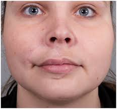 Full article: Microsurgically aided upper lip replantation