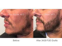 He is a researcher, an innovator, a teacher and a passionate facial surgeon. Facial Transplant Beard Hair Transplant Before And After Photos Los Angeles Hair Restoration