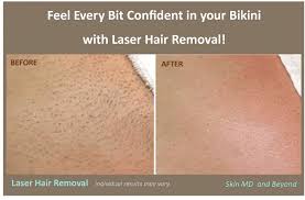 Sit in a hot bath for a few minutes or hop in the shower. Laser Hair Removal Plano Tx Frisco Tx