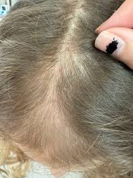 Image result for sores on the head in children