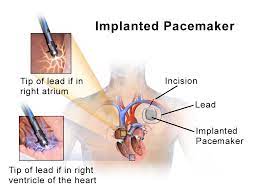 Pacemaker ships with most modern linux distributions and has been deployed in many critical environments including deutsche flugsicherung. Ù†Ø§Ø¸Ù…Ø© Ù‚Ù„Ø¨ÙŠØ© Ø§ØµØ·Ù†Ø§Ø¹ÙŠØ© ÙˆÙŠÙƒÙŠØ¨ÙŠØ¯ÙŠØ§
