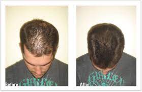 Tasks like growing hair, preventing hair loss and maintaining hair color and healthy nails. Hair Loss In Kidney Transplant Patients Avenueskapadia S Diary