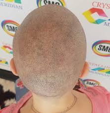 (when i grow my hair out, it. Scalp Micropigmentation Diffuse Thinning Treatments What Do I Need To Know Scalp Micro Portugal