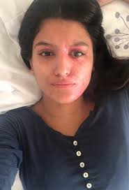 This acid-attack survivor shared no-makeup pictures after people doubted  her recovery