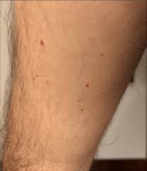 Cherry angiomas are circular or sometime oval shaped spots which are primarily cherry red in color. Cherry Angioma Like Lesions On The Medial Aspect Of The Upper Arm Download Scientific Diagram