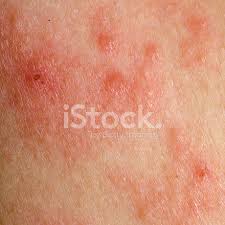 Das atopische ekzem ist eine erkrankung mit trockener, juckender und entzündeter haut, die bei menschen mit einem empfindlichen hauttyp auftritt. Ekzem Atopisches Ekzem Symptom Haut Stockfotos Freeimages Com