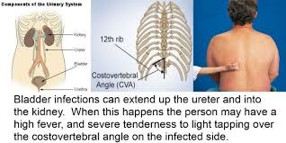 Bladder And Kidney Infections How To Treat Them During An Emergency Some Fish Antibiot Health Info Remedies For Kidney Infection Holistic Approach To Health