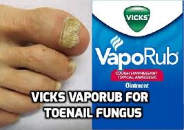 Vicks Vaporub For Toenail Fungus With Images Nail Fungus Cure Toenail Fungus Nail Fungus Treatment
