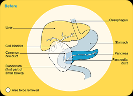 Cancer council south australia would like to acknowledge the traditional custodians of the land on which we live and work. Whipple For Early Pancreatic Nets Cancer Council Nsw