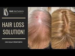 And how our hair loss consist of different phases and what are these phases all information provided over hair loss prevention with natural treatments is a good idea because they are secure, and best treated to retrieve critical hair loss problem in men and. Hair Loss Solution Cnc Installation K M Hair Systems Youtube Hair System Hair Loss Solutions Why Hair Loss