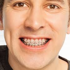 Traditional Braces