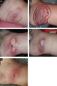 Image result for Spider Bite