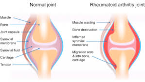 What Do You Really Know About Rheumatoid Arthritis North Shore Pro Active Health