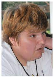 Как робин уильямс принял то решение. Facial Features Of A Prader Willi Syndrome Patient Periorbital Download Scientific Diagram