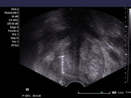 The american cancer society provides detailed information on prostate cancer and its treatment. Transrectal Ultrasound Guided Prostate Biopsy Radiology Reference Article Radiopaedia Org