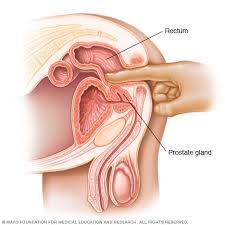 The pancreas is located behind the stomach, so having pancreatic cancer doesn't involve a palpable mass that you can feel. Prostate Cancer Diagnosis And Treatment Mayo Clinic