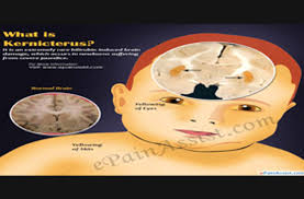 Image result for Kernicterus