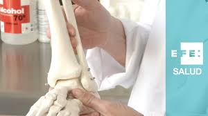 Siempre que hay una lesión de tobillo deberían hacer radiografías para descartar esta. Fractura De Perone De No Poder Apoyar El Pie Hasta Volver A Rendir Al Maximo