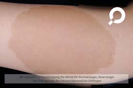 Wie wäre es mit einem warmen porridge mit früchten, gojibeeren und hausgemachtem mangopüree? Dermanostic Hautlexikon Cafe Au Lait Flecken