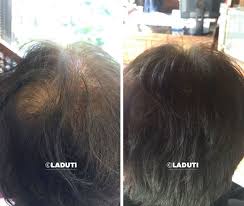 mittel gegen haarausfall laduti haarausfall haare mittel gegen haarausfall