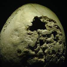 L late congenital latent syphilis l the period between secondary and tertiary syphilis. Neurosyphilis Wikipedia