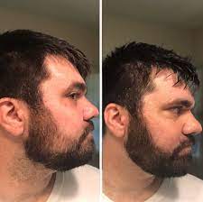 It's important to note that using 5% versus 2% will not necessarily give you faster hair growth results, but it will cause an increase in hair growth as well as being thicker. Minoxidil Before And After Beard Result Beardless Men Are Rubbing Hair Loss Drug On Their Face For Fuller Fuzz But Experts Warn It Could Fall Out And It S Safe But