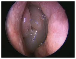 Diagnosis of polyposis is based on the patient's complaints once discovered nasal polyps, treatment is possible both conservative and surgical methods. Chronic Nasal Congestion And Hyposmia In A 22 Year Old Woman Cmaj