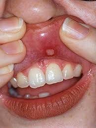 Canker Sore Canker Sore Gum Disease Treatment Oral Cancer