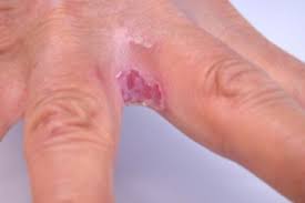 Image result for Candidiasis