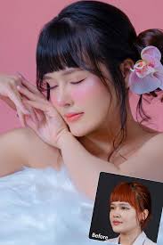 Phẫu Thuật Nâng Mũi Nội Soi 4K Vi Phẫu: Ưu Điểm Và Chi Phí