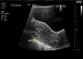 Ultrasonido Pelvico Ginecologico Dr Emmanuel Acuna