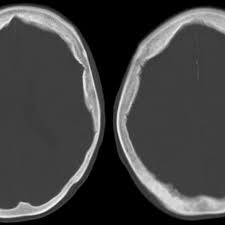 Although prostate cancer cells produce numerous osteogenic factors, to date, none have been shown to … Prostate Cancer Skull Metastasis Invading The Brain Eurorad