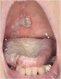 Image result for oral herpes symptoms roof of the mouth