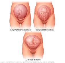 Medical illustration of uterine incision types used in cesarean delivery