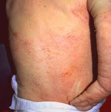 Eczema has a bad reputation: Severe Eczema Cancer Therapy Advisor