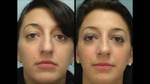 Rhinoplasty by Dr. Edwin Williams