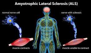 El síntoma más habitual es la pérdida de. Anatomia De La Esclerosis Lateral Amiotrofica 296311 Descargar Vectores Gratis Illustrator Graficos Plantillas Diseno
